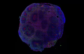 El consumo de agua contaminada se relaciona con la gravedad de las malformaciones causadas por el Zika